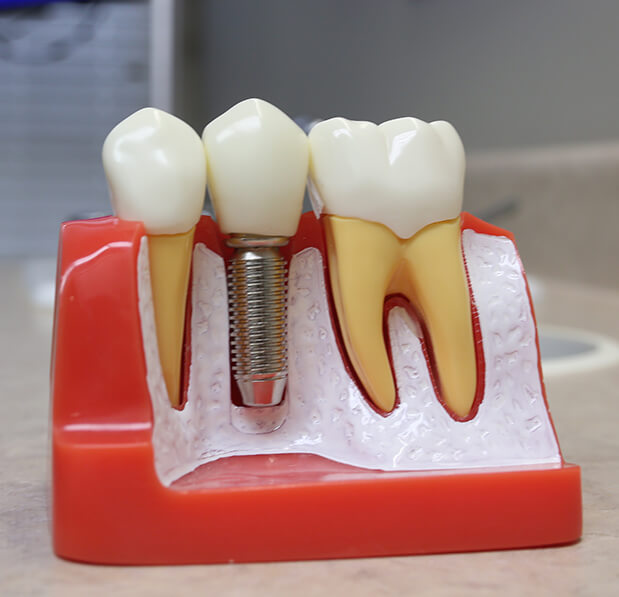 dental implant diagram model